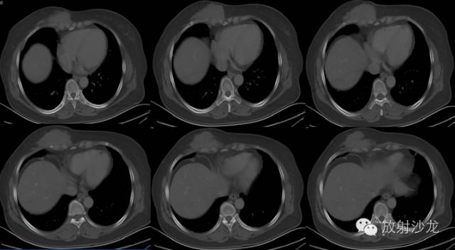 【病例】胸壁纤维瘤1例CT影像表现