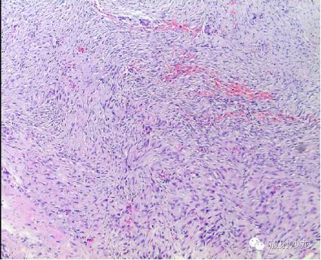 【病例】胸壁纤维瘤1例CT影像表现