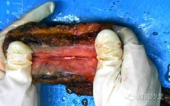 【病例】胸壁纤维瘤1例CT影像表现