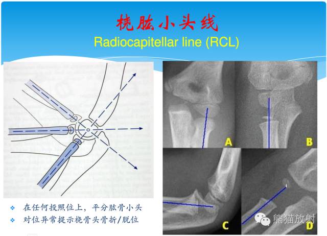 肘关节及前臂平片——临床影像示例