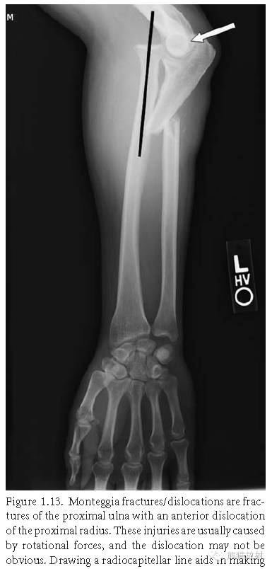肘关节及前臂平片——临床影像示例