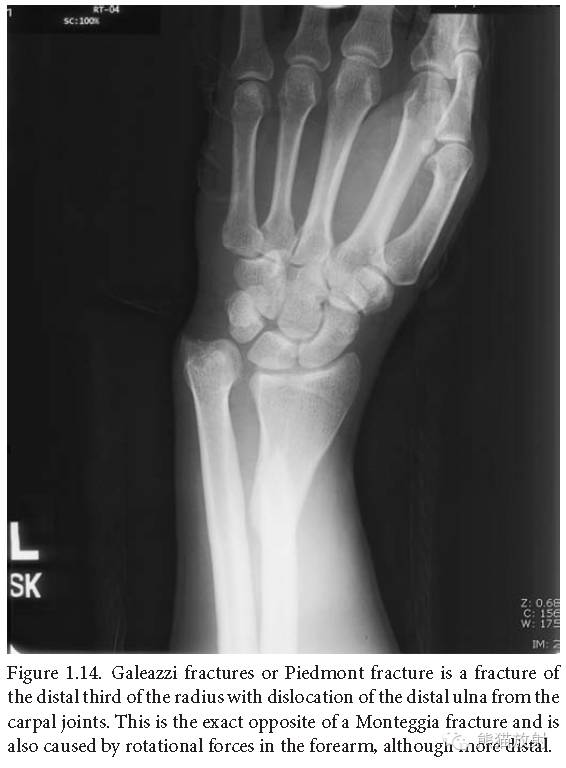 肘关节及前臂平片——临床影像示例