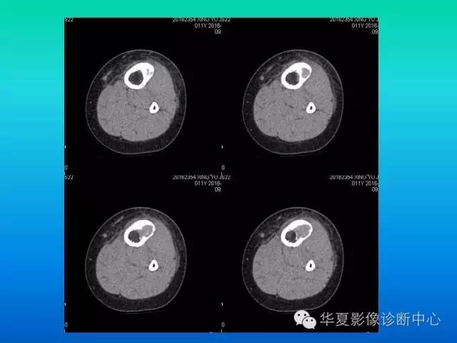 【病例】胫骨非骨化性纤维瘤1例CT影像表现