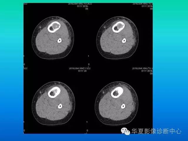 【病例】胫骨非骨化性纤维瘤1例CT影像表现