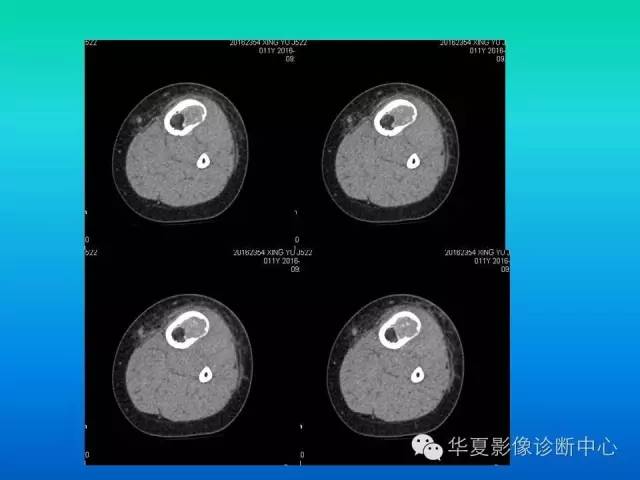 【病例】胫骨非骨化性纤维瘤1例CT影像表现