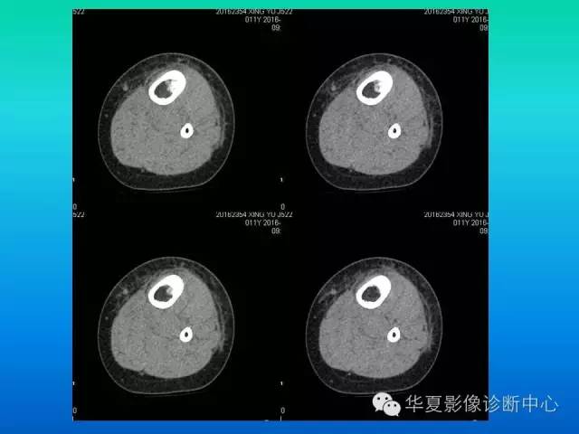 【病例】胫骨非骨化性纤维瘤1例CT影像表现