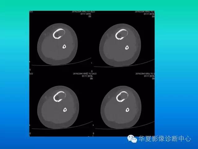 【病例】胫骨非骨化性纤维瘤1例CT影像表现