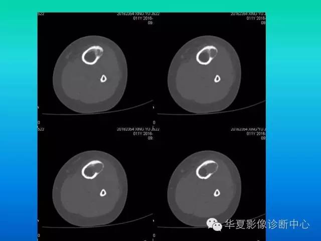 【病例】胫骨非骨化性纤维瘤1例CT影像表现