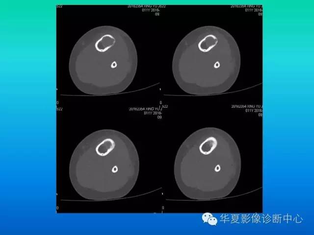 【病例】胫骨非骨化性纤维瘤1例CT影像表现