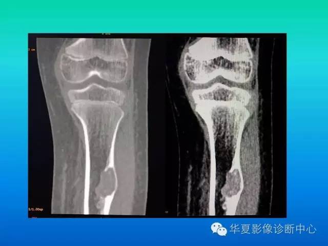 【病例】胫骨非骨化性纤维瘤1例CT影像表现