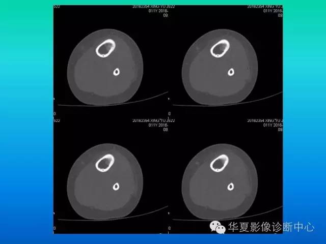 【病例】胫骨非骨化性纤维瘤1例CT影像表现