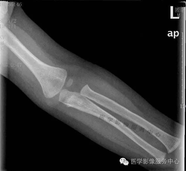 【漏诊病例】小儿外伤肘关节摄片,报告及审核医生均漏诊 【漏诊病例】小儿外伤肘关节摄片,报告及审核医生均漏诊