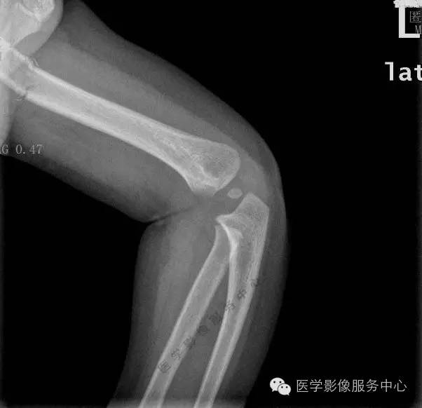 【漏诊病例】小儿外伤肘关节摄片,报告及审核医生均漏诊 【漏诊病例】小儿外伤肘关节摄片,报告及审核医生均漏诊