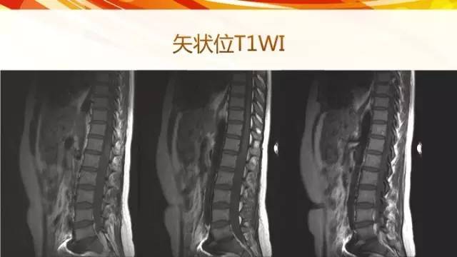 【病例】脊髓圆锥黏液乳头型室管膜瘤1例CT影像表现