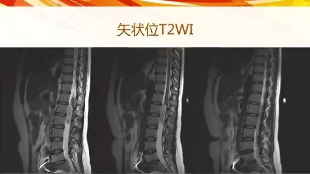 【病例】脊髓圆锥黏液乳头型室管膜瘤1例CT影像表现