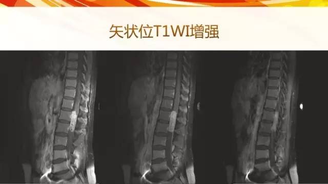 【病例】脊髓圆锥黏液乳头型室管膜瘤1例CT影像表现