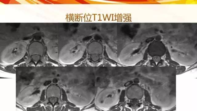 【病例】脊髓圆锥黏液乳头型室管膜瘤1例CT影像表现