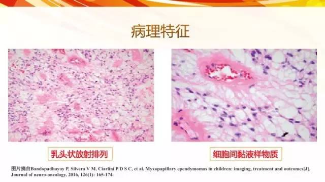 【病例】脊髓圆锥黏液乳头型室管膜瘤1例CT影像表现