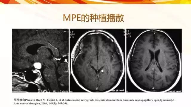 【病例】脊髓圆锥黏液乳头型室管膜瘤1例CT影像表现