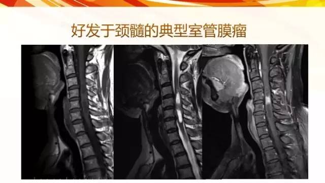 【病例】脊髓圆锥黏液乳头型室管膜瘤1例CT影像表现