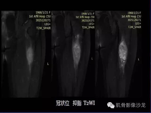 【病例】恶性外周神经鞘膜瘤1例MR影像表现