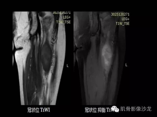 【病例】恶性外周神经鞘膜瘤1例MR影像表现