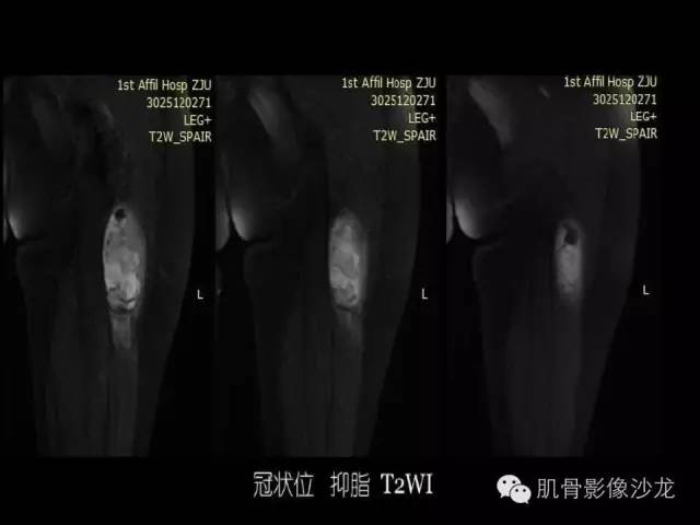 【病例】恶性外周神经鞘膜瘤1例MR影像表现