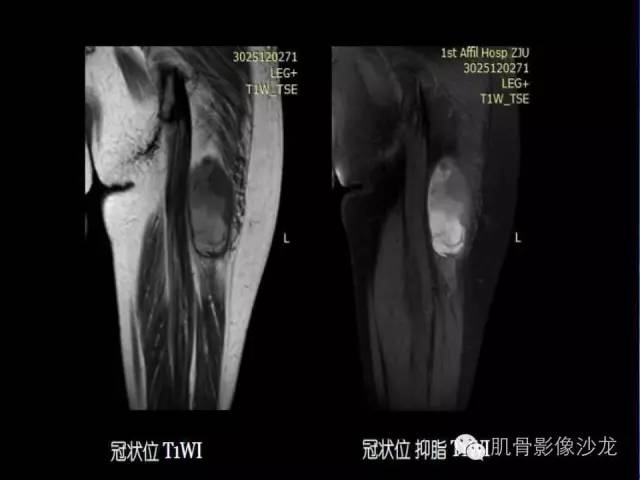 【病例】恶性外周神经鞘膜瘤1例MR影像表现