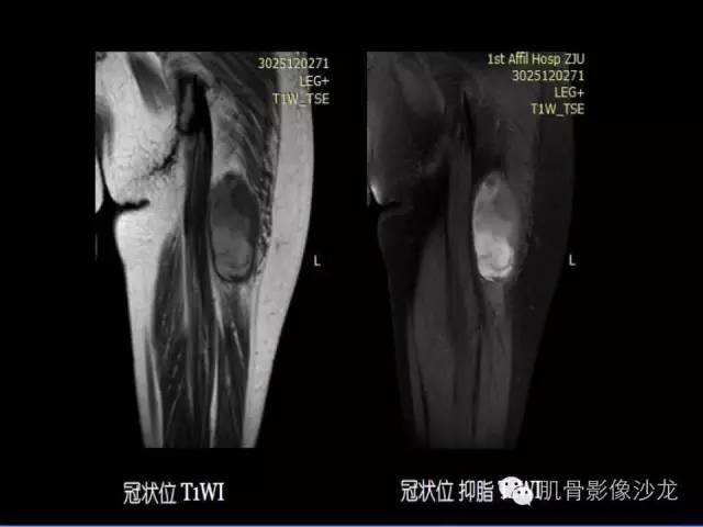 【病例】恶性外周神经鞘膜瘤1例MR影像表现