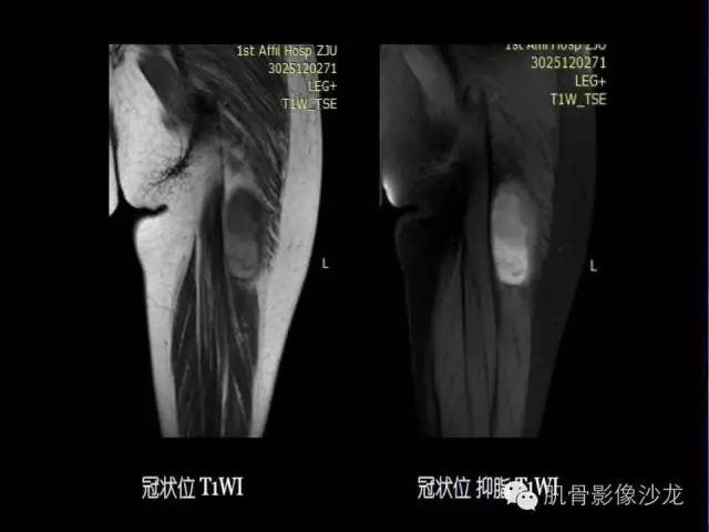【病例】恶性外周神经鞘膜瘤1例MR影像表现