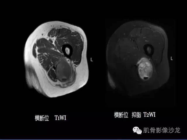 【病例】恶性外周神经鞘膜瘤1例MR影像表现