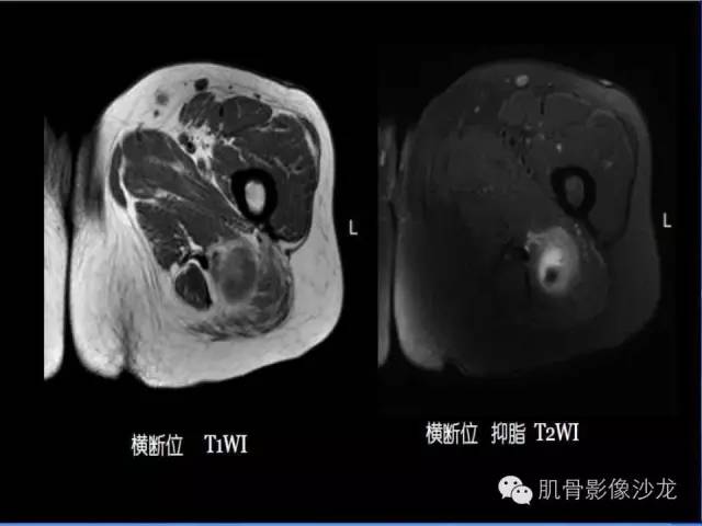 【病例】恶性外周神经鞘膜瘤1例MR影像表现
