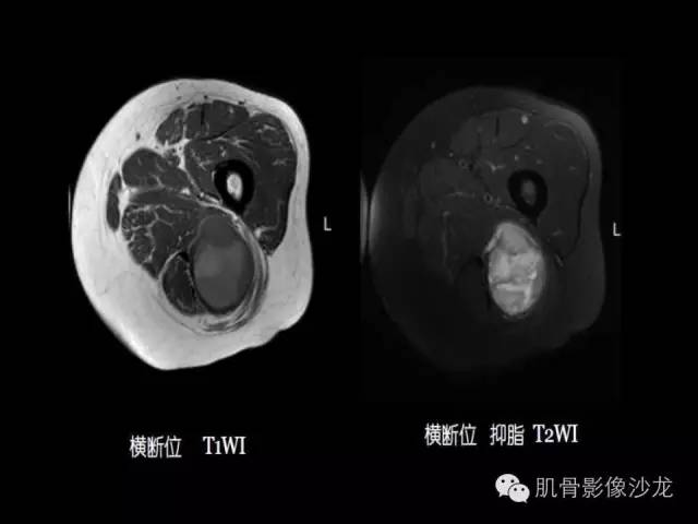 【病例】恶性外周神经鞘膜瘤1例MR影像表现