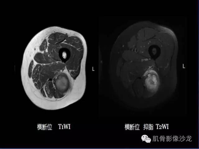 【病例】恶性外周神经鞘膜瘤1例MR影像表现