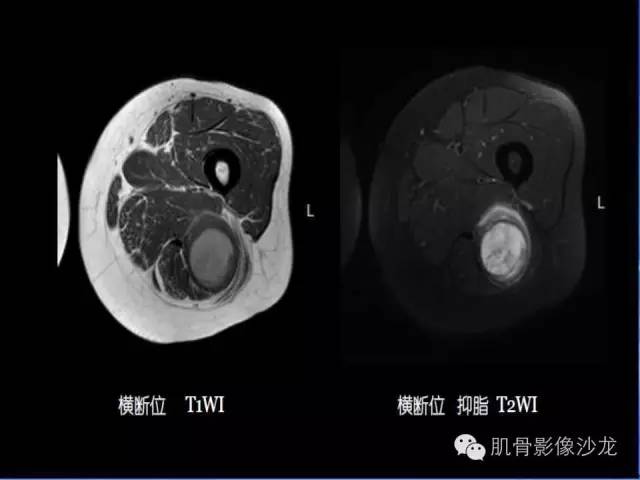 【病例】恶性外周神经鞘膜瘤1例MR影像表现