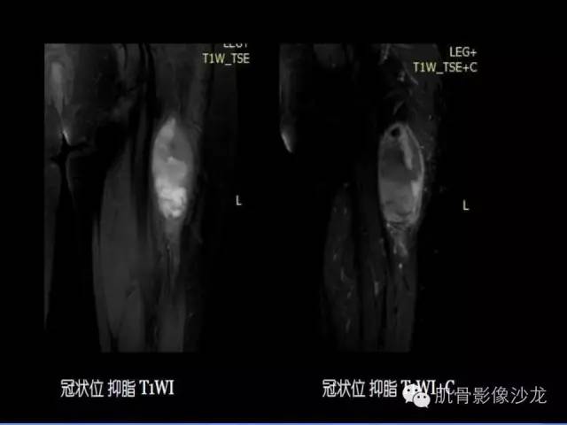 【病例】恶性外周神经鞘膜瘤1例MR影像表现