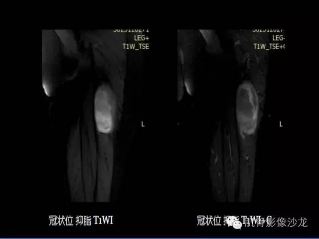 【病例】恶性外周神经鞘膜瘤1例MR影像表现