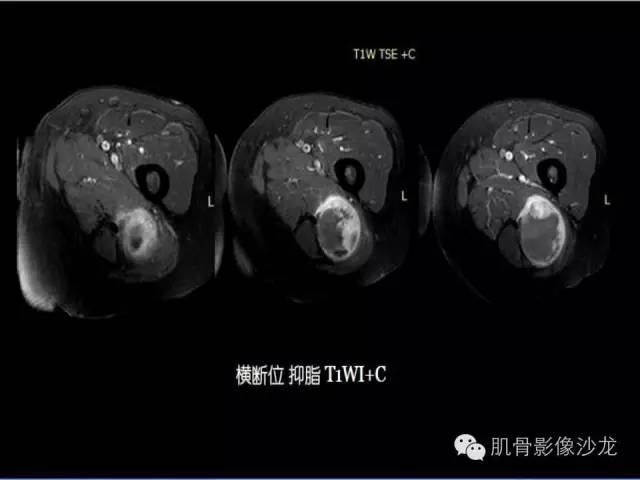 【病例】恶性外周神经鞘膜瘤1例MR影像表现