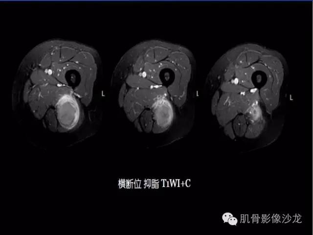【病例】恶性外周神经鞘膜瘤1例MR影像表现