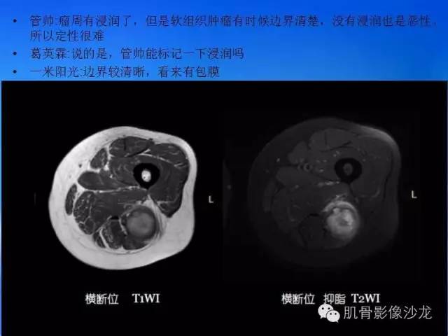 【病例】恶性外周神经鞘膜瘤1例MR影像表现