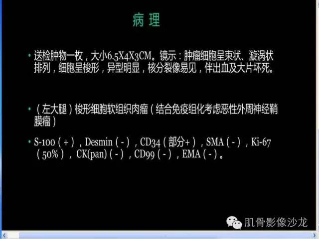 【病例】恶性外周神经鞘膜瘤1例MR影像表现