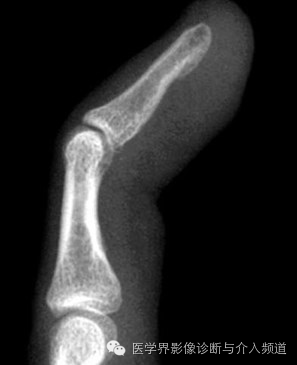 涨知识!20种骨折平片你见过几种? 涨知识!20种骨折平片你见过几种?