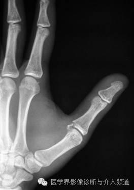 涨知识!20种骨折平片你见过几种? 涨知识!20种骨折平片你见过几种?