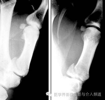 涨知识!20种骨折平片你见过几种? 涨知识!20种骨折平片你见过几种?