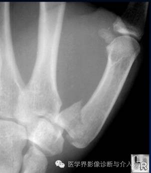 涨知识!20种骨折平片你见过几种? 涨知识!20种骨折平片你见过几种?