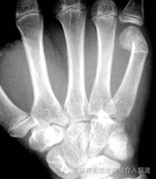 涨知识!20种骨折平片你见过几种? 涨知识!20种骨折平片你见过几种?