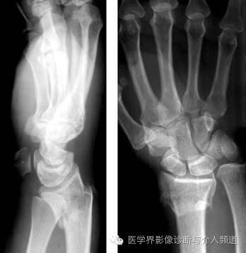 涨知识!20种骨折平片你见过几种? 涨知识!20种骨折平片你见过几种?