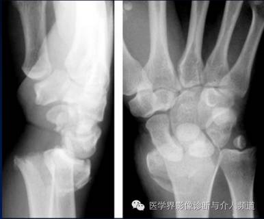 涨知识!20种骨折平片你见过几种? 涨知识!20种骨折平片你见过几种?