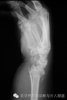 涨知识!20种骨折平片你见过几种? 涨知识!20种骨折平片你见过几种?
