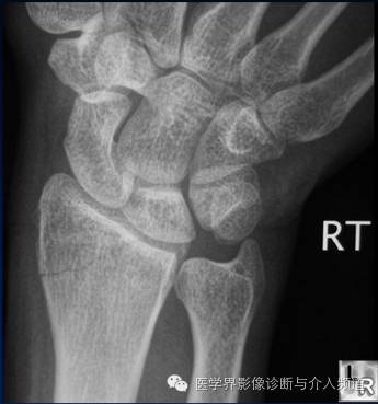 涨知识!20种骨折平片你见过几种? 涨知识!20种骨折平片你见过几种?